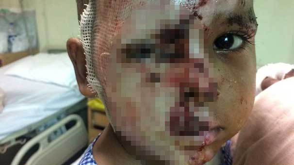 İki yaşındaki çocuğun yüzünü asitle yaktı