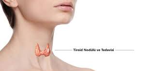 Tiroid Nodülü Nedir Tedavi Yöntemleri Nelerdir