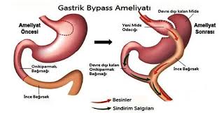 Bypass Ameliyatı Nedir