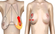 Göğüs Estetiği ve Dikleştirme Uygulamaları