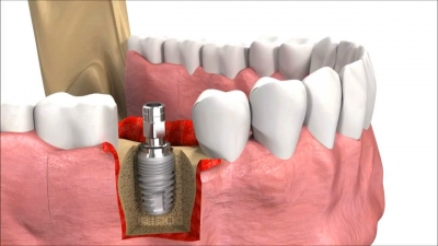 İmplant Nedir Ve Tedavi Yöntemi Nasıl Gerçekleşir ?